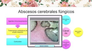 Abscesos cerebrales fúngicos
Corticoides
Tratamientos antibióticos de
amplio espectro
Agentes inmunosupresores
Cándi
da
Microabsce
sos
Macroabsc
esos
Granuloma
s no
caseificant
es
Nódulos
gliales
difusos
 