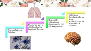 Aspergillus spp.
Adultos
Pulmones son el
sitio habitual de
la primoinfección
Dispersión
intracraneal
diseminación del
microorganismo
Extensión
directa desde un
área
anatómicamente
adyacente al
cerebro
 