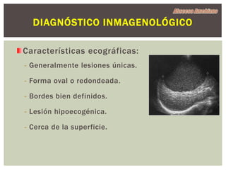 DIAGNÓSTICO INMAGENOLÓGICO

Características ecográficas:
- Generalmente lesiones únicas.

- Forma oval o redondeada.

- Bordes bien definidos.

- Lesión hipoecogénica.

- Cerca de la superficie.
 