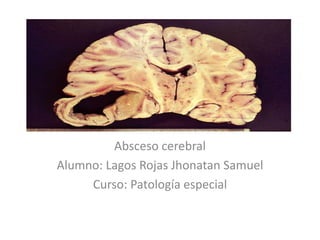 ABSCESO
Absceso cerebral
Alumno: Lagos Rojas Jhonatan Samuel
Curso: Patología especial
 