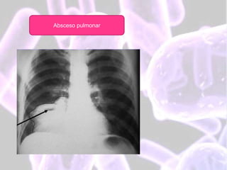 Absceso pulmonar
 