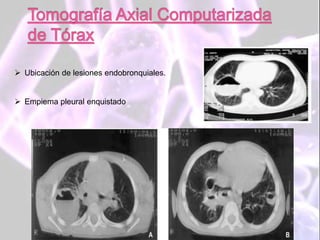  Ubicación de lesiones endobronquiales.
 Empiema pleural enquistado
 