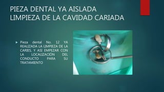 PIEZA DENTAL YA AISLADA
LIMPIEZA DE LA CAVIDAD CARIADA
 Pieza dental No. 12 YA
REALIZADA LA LIMPIEZA DE LA
CARIES, Y ASI EMPEZAR CON
LA LOCALIZACIÓN DEL
CONDUCTO PARA SU
TRATAMIENTO
 