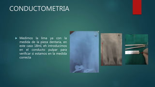 CONDUCTOMETRIA
 Medimos la lima ya con la
medida de la pieza dentaria, en
este caso 18ml, eh introducimos
en el conducto pulpar para
verificar si estamos en la medida
correcta
 