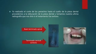  Ya realizado el corte de los penachos hasta el cuello de la pieza dental
procedemos a la obturación de la pieza dental y tomamos nuestra ultima
radiografía que nos dirá si el tratamiento fue exitoso.
Buen terminado apical
Terminado cervical
correcto
 