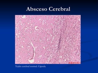 Absceso Cerebral  Tejido cerebral normal. Cápsula. 