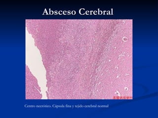 Absceso Cerebral  Centro necrótico. Cápsula fina y tejido cerebral normal 