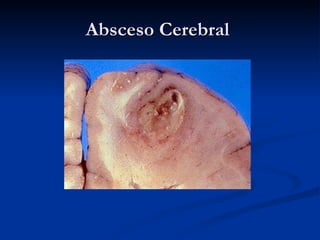 Absceso Cerebral  
