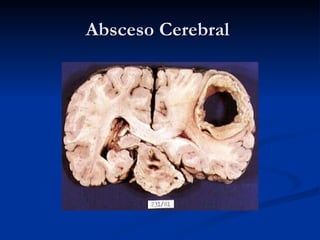 Absceso Cerebral  