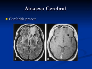 Absceso Cerebral  Cerebritis precoz 