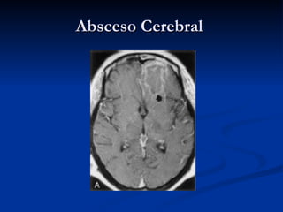 Absceso Cerebral  