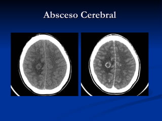 Absceso Cerebral  