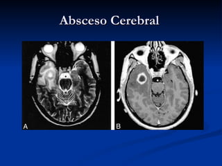 Absceso Cerebral  