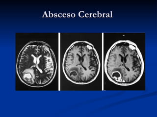Absceso Cerebral  