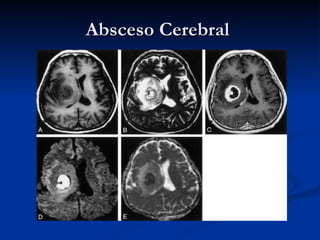 Absceso Cerebral  