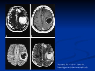 Paciente de 57 años. Estudio histológico revelo una metástasis 