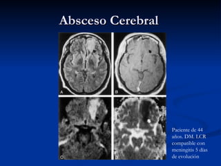 Absceso Cerebral  Paciente de 44 años. DM. LCR compatible con meningitis 5 días de evolución 