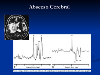 Absceso Cerebral   