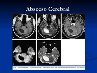 Absceso Cerebral  