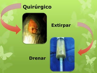 Quirúrgico


           Extirpar




  Drenar
 
