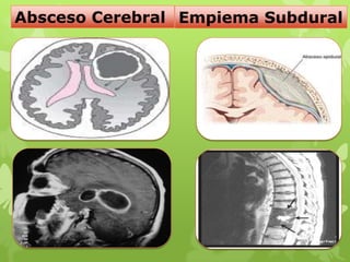 Absceso Cerebral Empiema Subdural
 