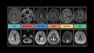 Comprehensive Overview of Brain Abscess: Diagnosis, Etiology, and ...