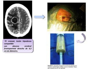 TC craneal, lesión hipodensa
TC craneal, lesión hipodensa
compatible
compatible
con
absceso
cerebral
con
absceso
cerebral
frontoparietal derecho de 4,3
frontoparietal derecho de 4,3
cm de diámetro.
cm de diámetro.

 