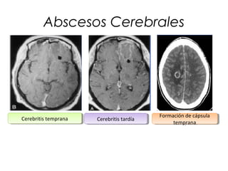 Abscesos Cerebrales

Cerebritis temprana
Cerebritis temprana

Cerebritis tardía
Cerebritis tardía

Formación de cápsula
Formación de cápsula
temprana
temprana

 