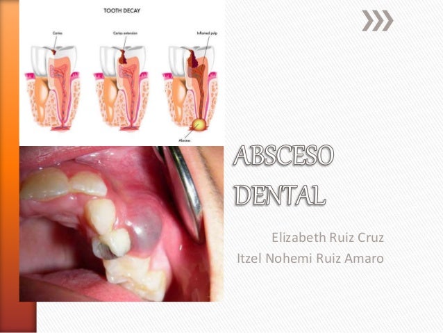 absceso dental