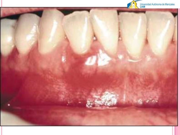 absceso periodontal