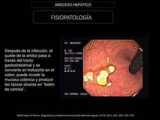 FISIOPATOLOGÍA
ABSCESO HEPÁTICO
Rafael Aguirre Rivero, Diagnóstico y tratamiento actual del abdomen agudo, 2ª Ed. 2011, Edit. Alfil: 142–170.
Después de la infección, el
quiste de la amiba pasa a
través del tracto
gastrointestinal y se
convierte en trofozoíto en el
colon; puede invadir la
mucosa colónica y producir
las típicas úlceras en “botón
de camisa”.
 