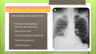 Diagnóstico Imagenológico
Rx simple de abdomen:
- Niveles hidroaéreos
dentro del absceso.
- Elevación del
hemidiafragma derecho.
- Derrame pleural.
- Atelectasias.
 