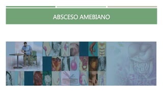 ABSCESO AMEBIANO
 