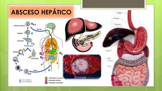 ABSCESO HEPÁTICO
 