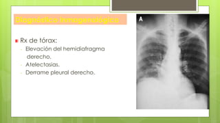 Diagnóstico Inmagenológico
Rx de tórax:
- Elevación del hemidiafragma
derecho.
- Atelectasias.
- Derrame pleural derecho.
 