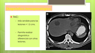 Diagnóstico Inmagenológico
TAC:
- Más sensible para las
lesiones < 1.5 cms.
- Permite realizar
diagnóstico
diferencial con otras
lesiones.
 