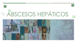 ABSCESOS HEPÁTICOS
 