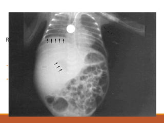 IMAGENOLOGIA
Rx simple de abdomen:
- Niveles Hidroaéreos dentro del
absceso.
- Elevación del hemidiafragma derecho.
- Derrame pleural.
 