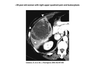 Catalano, O. et al. Am. J. Roentgenol. 2004;182:447-450
--39-year-old woman with right upper quadrant pain and leukocytosis
 