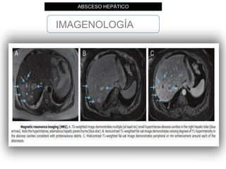 IMAGENOLOGÍA
ABSCESO HEPÁTICO
The Evolving Nature of Hepatic Abscess: A Review, J Clinical and Translational Hepatology. 2016 Jun 28; 4(2): 158–168.
 