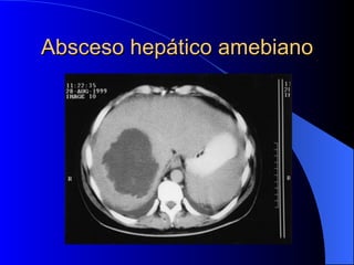 Absceso hepático amebiano 
