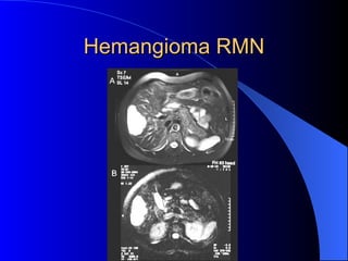 Hemangioma RMN 