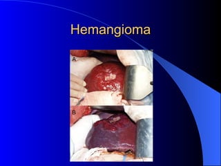 Hemangioma 