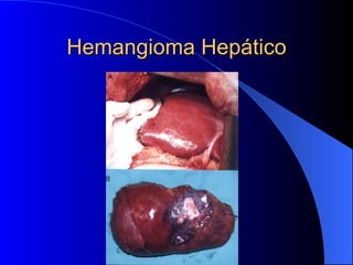 Hemangioma Hepático 