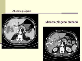 Absceso piógeno
Absceso piógeno drenado
 