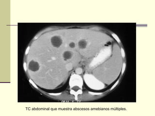 TC abdominal que muestra abscesos amebianos múltiples.
 