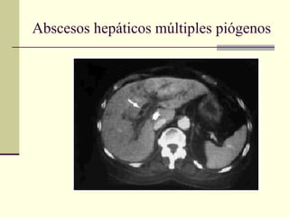 Abscesos hepáticos múltiples piógenos
 
