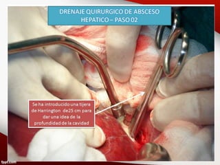 Cirugía a cielo abierto (laparotomía
exploradora). De acuerdo a criterio
médico, podría efectuarse en lugar de
la punción evacuadora del absceso de
acuerdo a los mismos criterios.
 