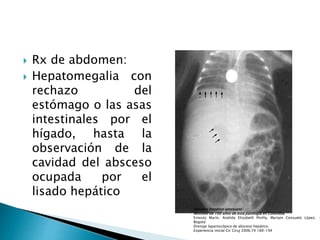  Rx de abdomen:
 Hepatomegalia con
rechazo del
estómago o las asas
intestinales por el
hígado, hasta la
observación de la
cavidad del absceso
ocupada por el
lisado hepático
Absceso hepático amebiano
Revisión de 100 años de esta patología en Colombia
Ernesto Marín, Análida Elizabeth Pinilla, Myriam Consuelo López. ·
Bogotá
Drenaje laparoscópico de absceso hepático.
Experiencia inicial Cir Ciruj 2006;74:189-194
 