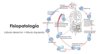 Fisiopatología
Lóbulo derecho > lóbulo izquierdo
 